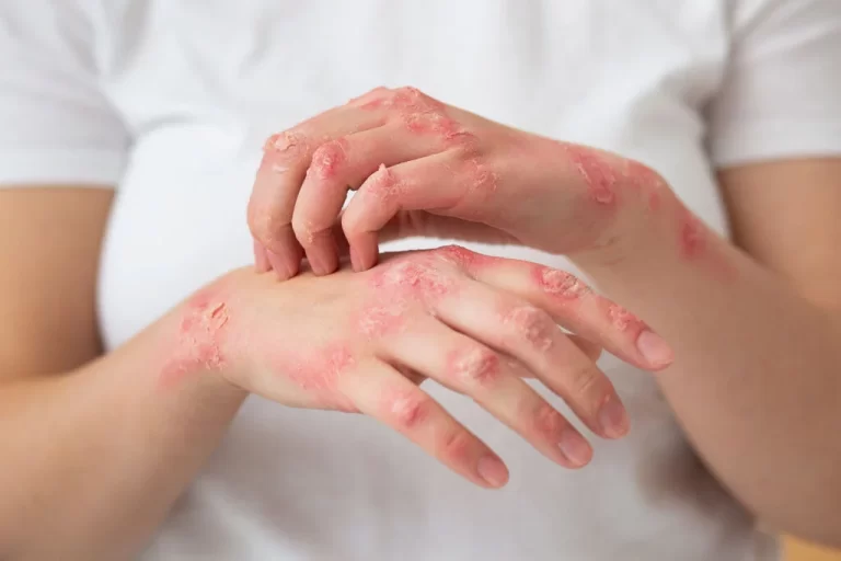 Psoriasis