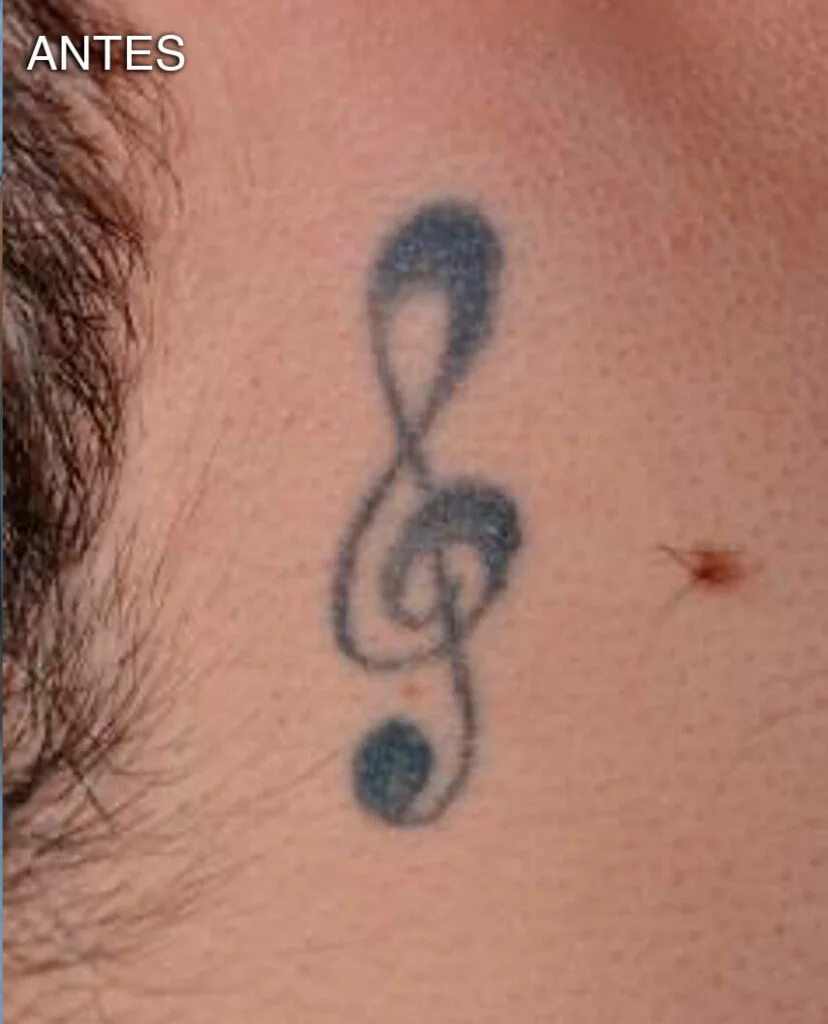 Remoción de tatuajes