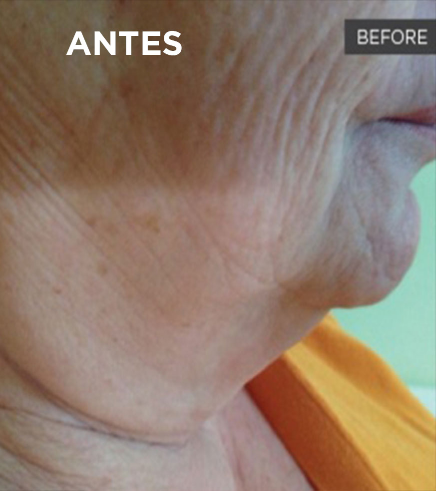Lifting Facial