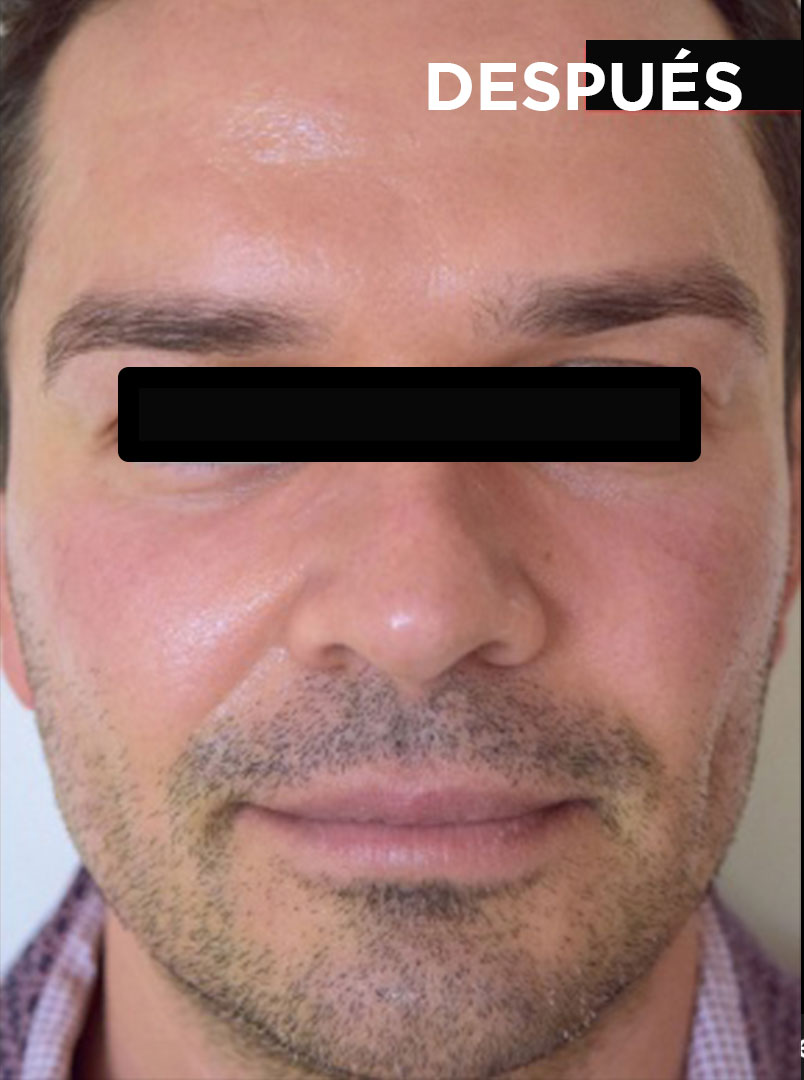 Lifting Facial