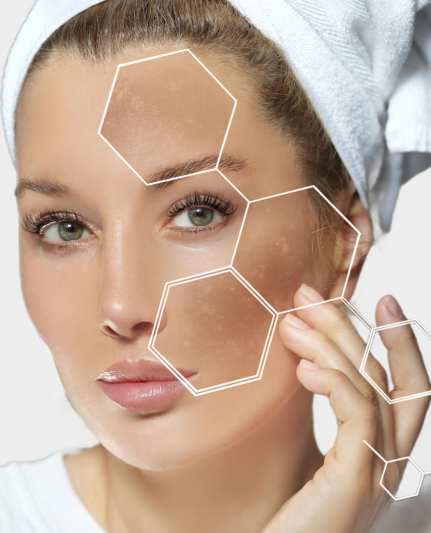 melasma