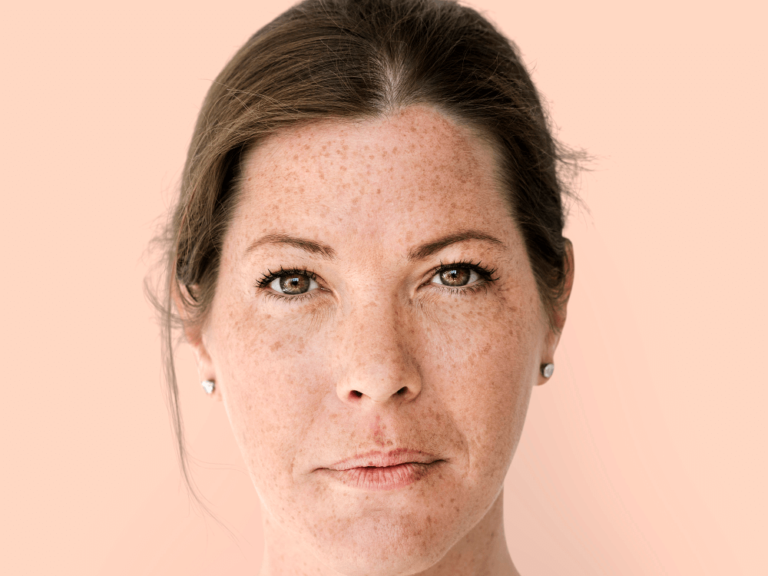 Melasma