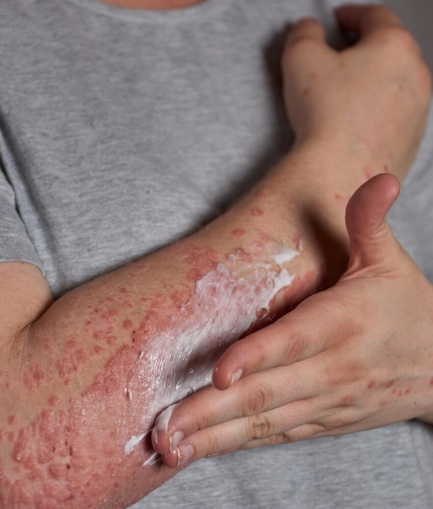 Alergia en la Piel