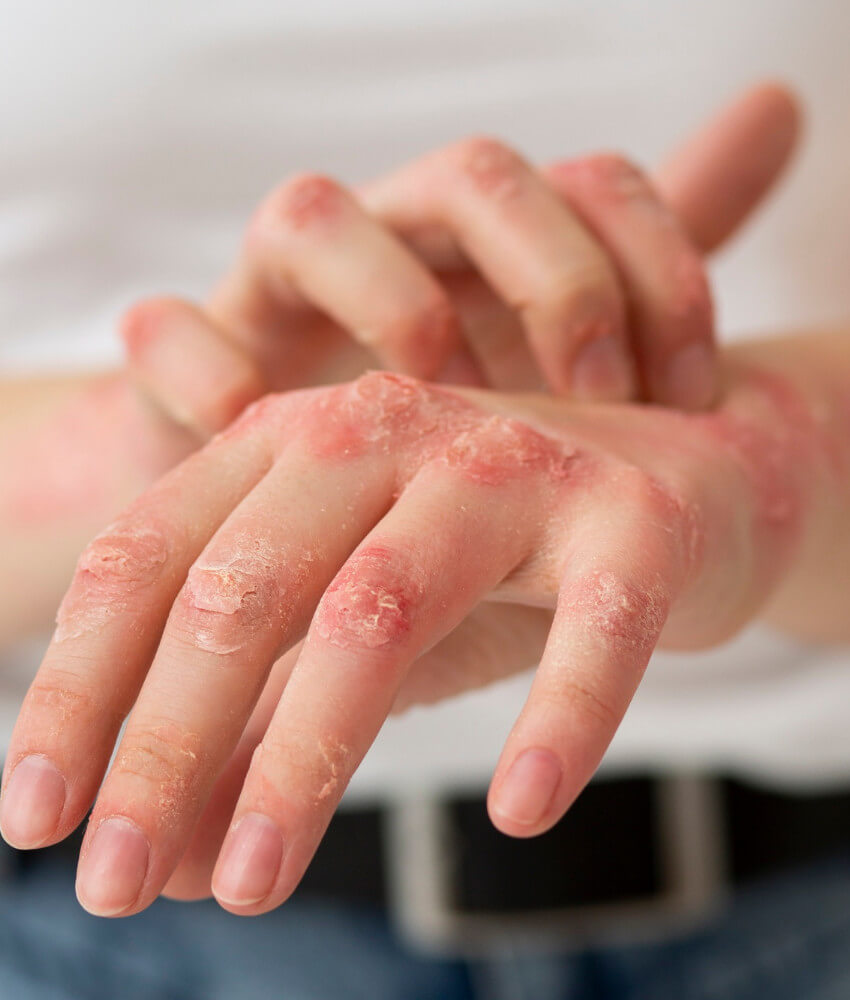 Psoriasis en la piel