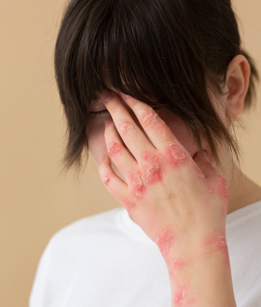 Psoriasis en la piel