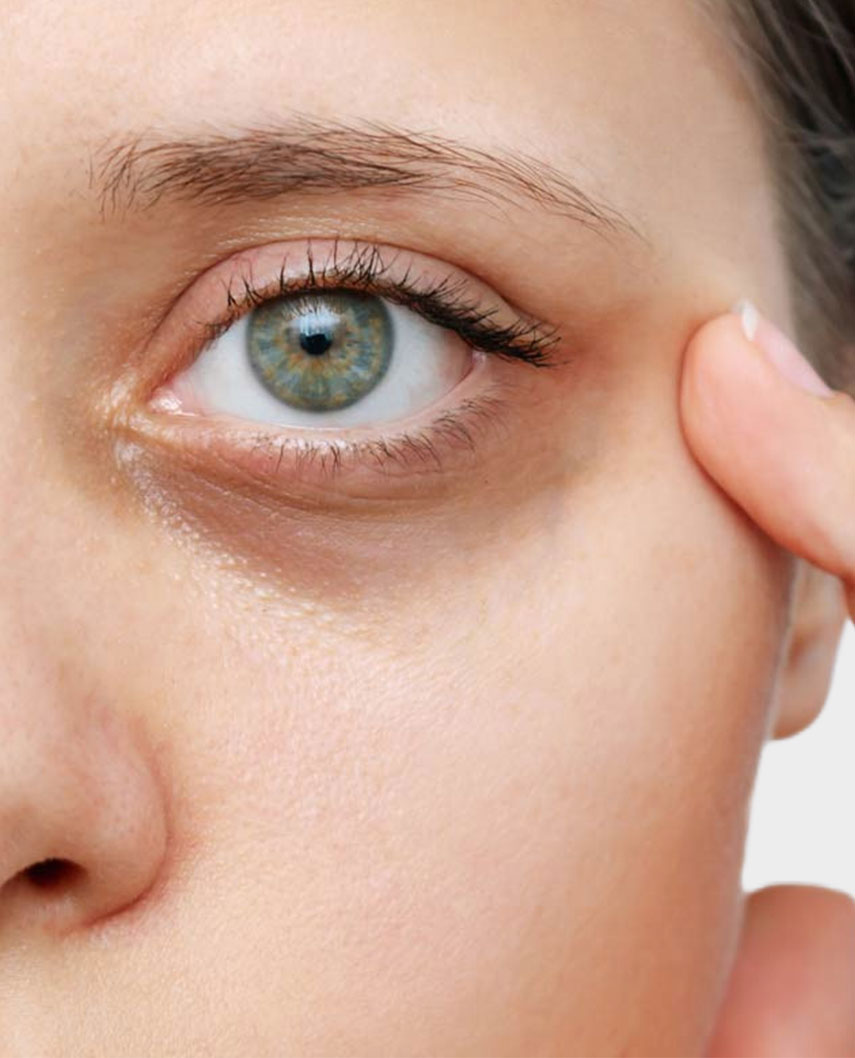ojeras